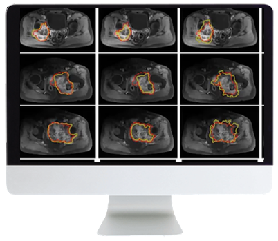 Crossroads of Computational Science and Musculoskeletal Imaging: Where Machine Magic Can Aid Radiologists