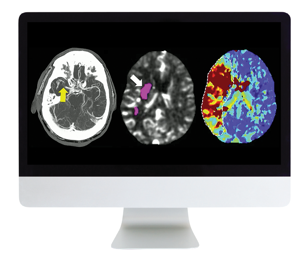 Code Stroke: What Every Radiologist Should Know Online Course