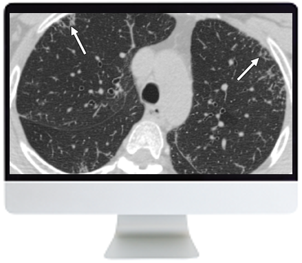 What Diagnostic Radiologists Need to Know About Vaping-Associated Lung  Injuries